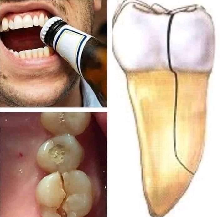 The dangers of using your teeth as bottle openers